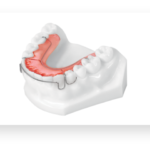 Mandibular Hawley Appliance