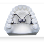 Rapid palatal expander