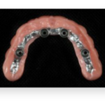 Screw-Retained-Hybrid-Denture-768x512-1-pj7v4lhem7o9yf3suwj92oskdkv04vvmfiei7cl32o