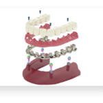 Zirconia crown over metal base